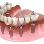 Teeth Implants Information Advantages of Teeth Implants Procedure