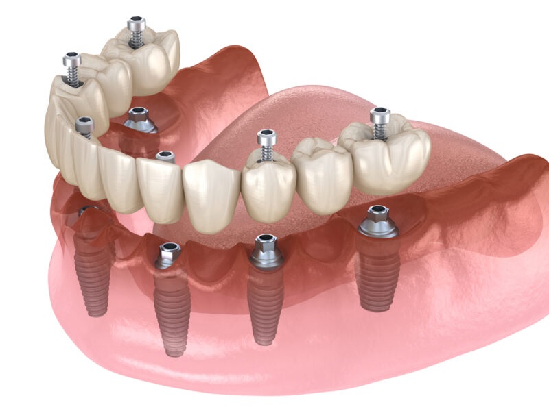 Teeth Implants Information Advantages of Teeth Implants Procedure