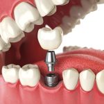 Great Cosmetic Dental Work Means Not only Teeth Implants