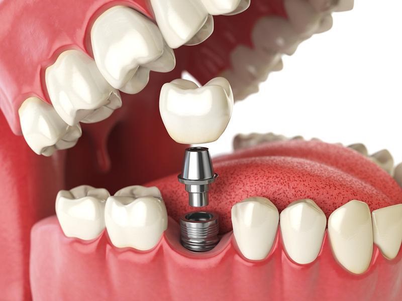 Great Cosmetic Dental Work Means Not only Teeth Implants