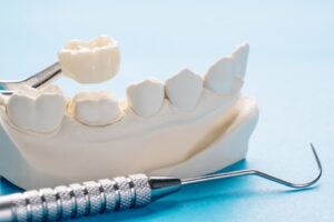 Exploring the Top 5 Types of Dental Crown