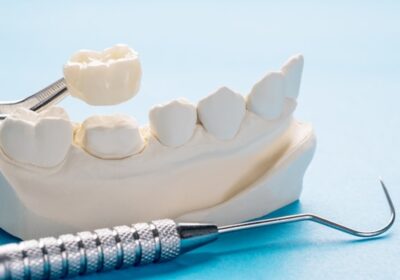 Exploring the Top 5 Types of Dental Crown