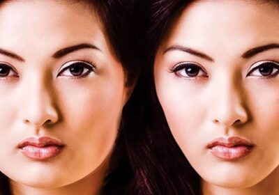 Understanding the Benefits Offered by V-Shaped Facial Thread Lifting