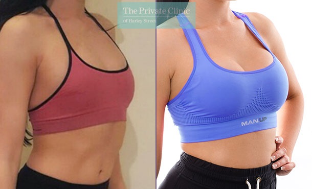 Breast Augmentation in Turkey