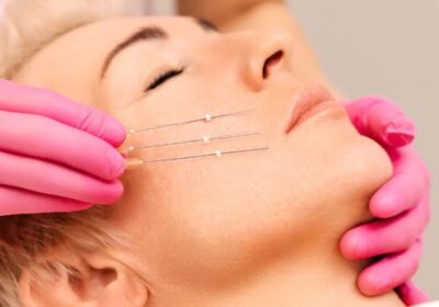Thread Lifting (無針埋線): A Modern Approach to Facial Rejuvenation