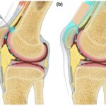 The Role of Stemcellcure in Treating Osteoarthritis with Stem Cell Therapy