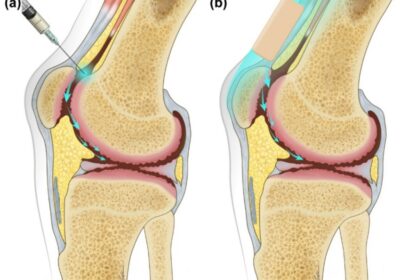 The Role of Stemcellcure in Treating Osteoarthritis with Stem Cell Therapy