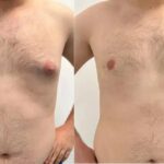 Understanding Gynecomastia: Glandular Tissue vs. Fat – What’s the Difference