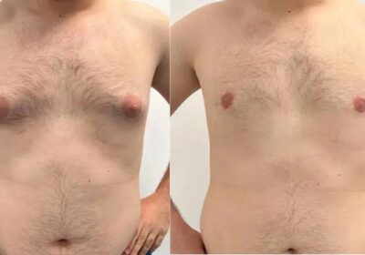 Understanding Gynecomastia: Glandular Tissue vs. Fat – What’s the Difference