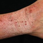 lichen-simplex-chronicus-scaled