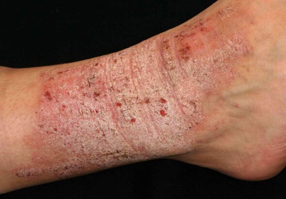 lichen-simplex-chronicus-scaled