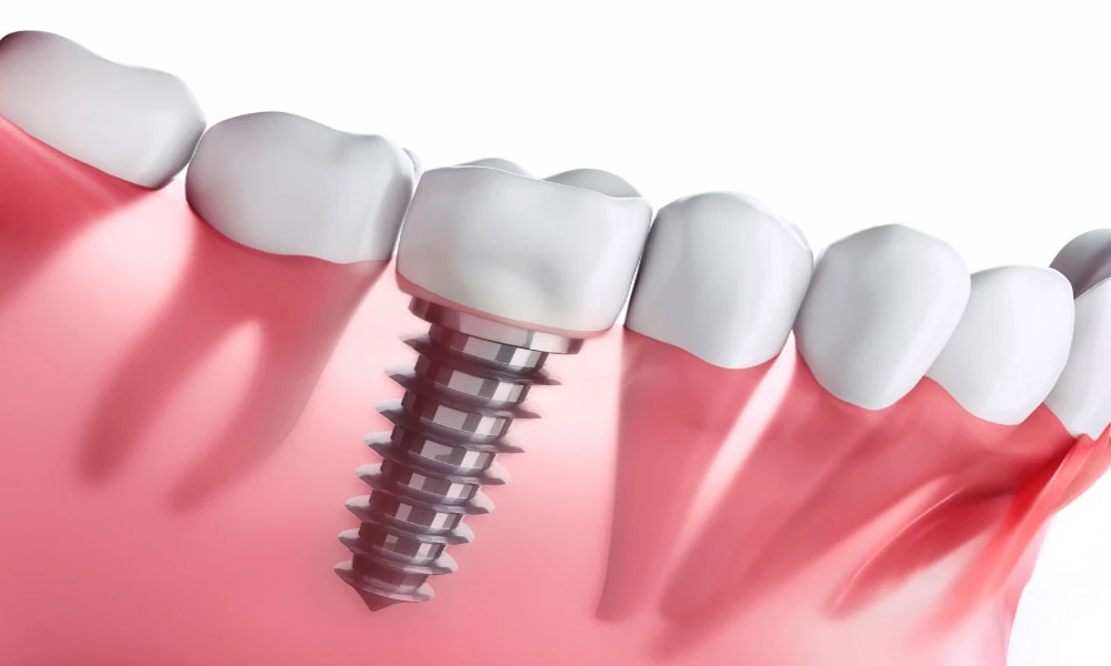 How Implant Dentistry Offers A Permanent Solution For Missing Teeth