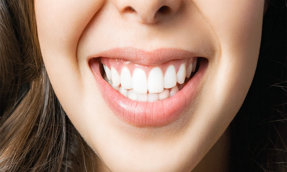 6 Factors That Influence How Long Teeth Whitening Results Really Last